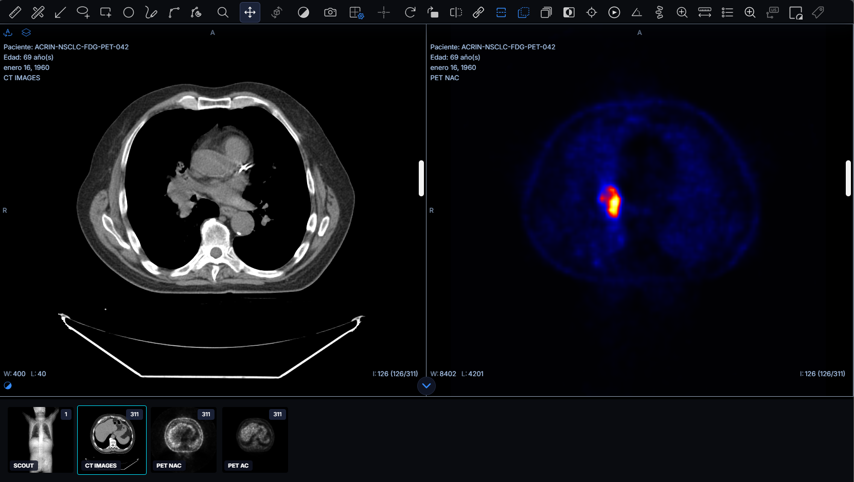 Fusión PET-CT